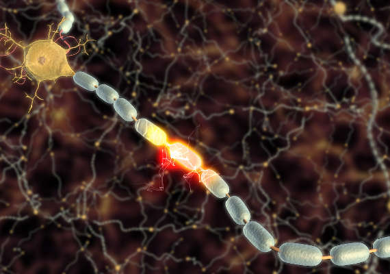Neuron showing loss of electrical impulse due to sclerosing of schwann cells. As seen in MS Multiple Sclerosis